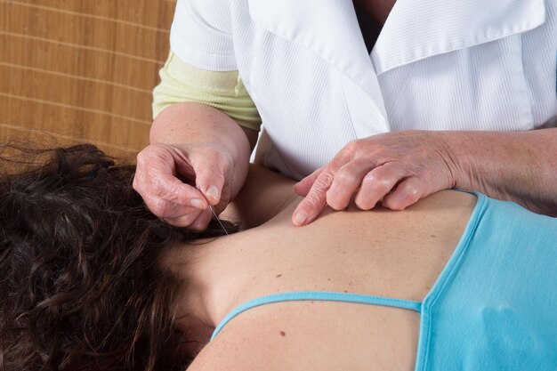 Femme caucasienne brillante recevant un traitement d'acupuncture dans un spa de santé