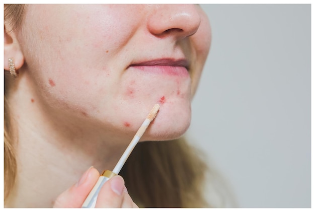 La femme couvre l'acné avec un correcteur Maquillage pour les peaux grasses à problèmes