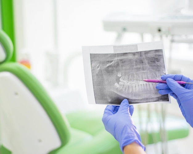 Femme dentiste tenant une radiographie dentaire L'infirmière tient une radiographie de la mâchoire humaine et pointe vers une dent avec des caries Bureau du parodontiste