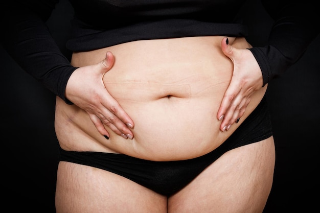 Une femme avec un gros ventre et des vergetures sur sa peau sur fond noir personne obèse photo de haute qualité