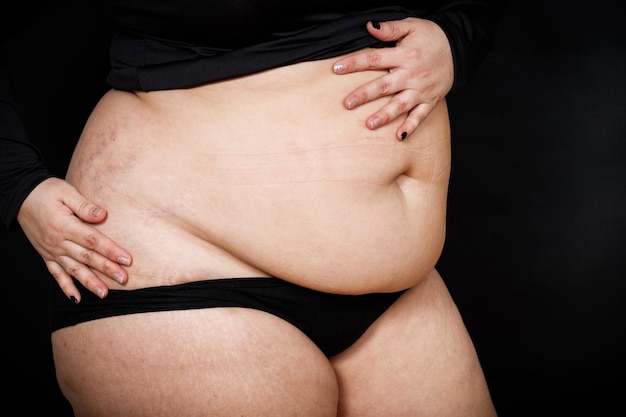 Une femme avec un gros ventre et des vergetures sur sa peau sur fond noir personne obèse