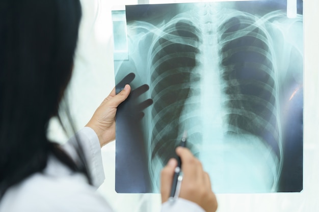 Femme médecin examinant les poumons avec un film radiographique