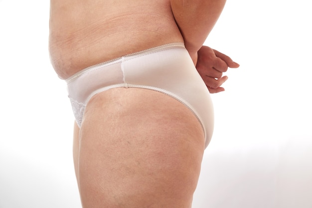 Femme plus âgée avec cellulite et vergetures