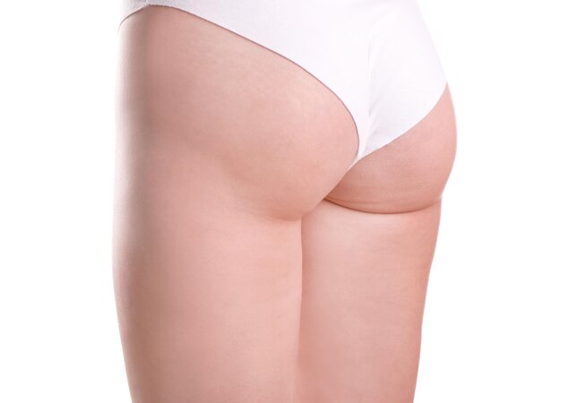 Femme avec problème de cellulite sur fond blanc