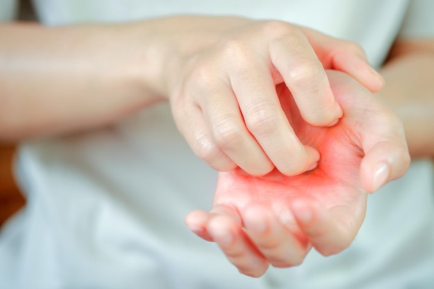 Femme qui démange les mains en raison d'une allergie chimique Concept de soins de santé