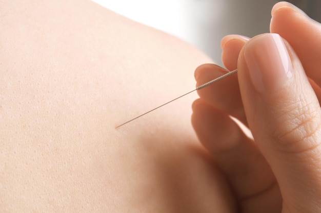 Femme stimulant les points d'acupuncture sur le gros plan du dos du patient