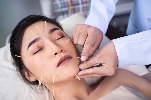 Femme subissant un traitement d'acupuncture sur le visage