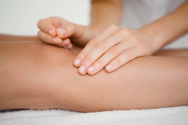 Femme tenant une aiguille dans une thérapie d&#39;acupuncture