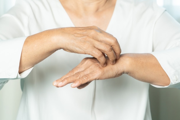 Les femmes âgées grattent les démangeaisons sur la main de l'eczéma, les soins de santé et le concept de médecine