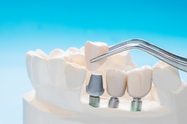 Fermez Le Bridge De Fixation Pour Implants Dentaires Implan Et La Couronne.