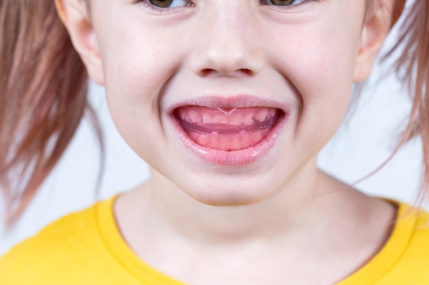 Une fille de race blanche de six ans montre un entraîneur myofonctionnel dans sa bouche