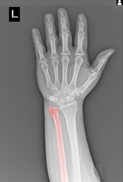 Film De Fracture De La Main Aux Rayons X Ulna.