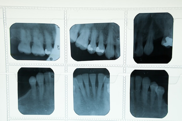 Photo film radiographique dentaire pour concept de soins dentaires