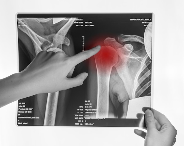 Film radiographique de l'épaule Radiographie du traumatisme de la lésion osseuse de la clavicule