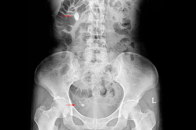 Film radiographique d'un patient avec plusieurs calculs rénaux et urétéraux