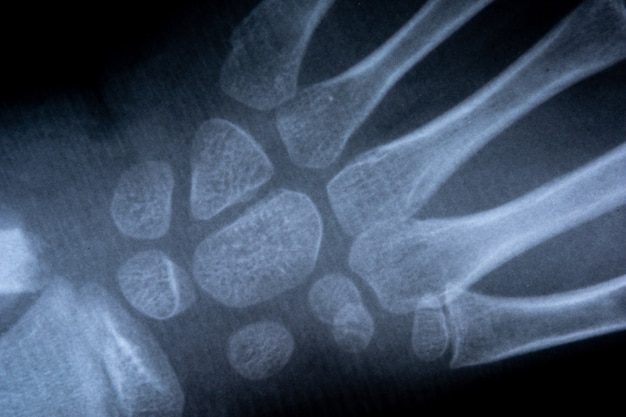 Film radiologique squelette du bras humain. concept corps santé anatomie médicale