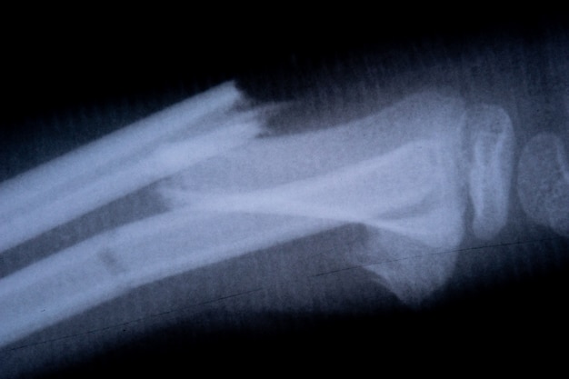 Photo film radiologique squelette du bras humain. concept corps santé anatomie médicale