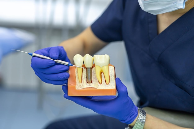 Photo formation, éducation, pratique du travail de dentiste. modèle de démonstration d'implant dentaire, couronne. simuler les dents dans une clinique dentaire