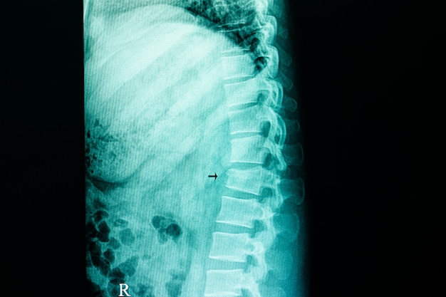 Fracture de compression de la colonne lombaire