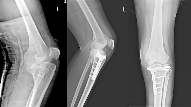 Photo fracture du genou par rayons x au tibia proximal et fracture du post-fix au tibia proximal.