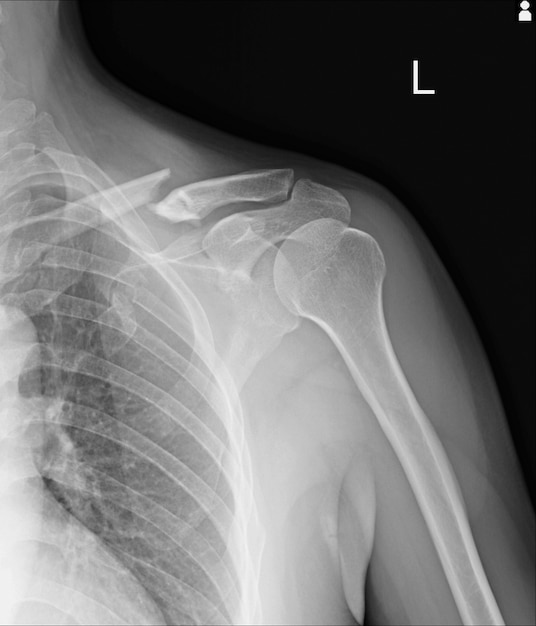 Fractures de radiographie thoracique, clavicule gauche, 2e côte antérieure,