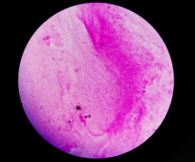 Frottis d'expectoration sous microscopie montrant des bactéries cocci à Gram positif