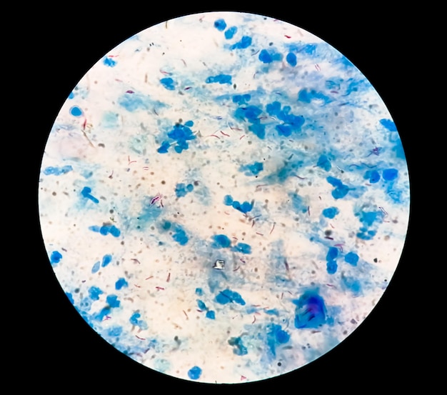 Frottis d'expectorations ou de mucosités Coloration AFB sous microscopie montrant des bactéries de la tuberculose Macrobacterium (MTB)