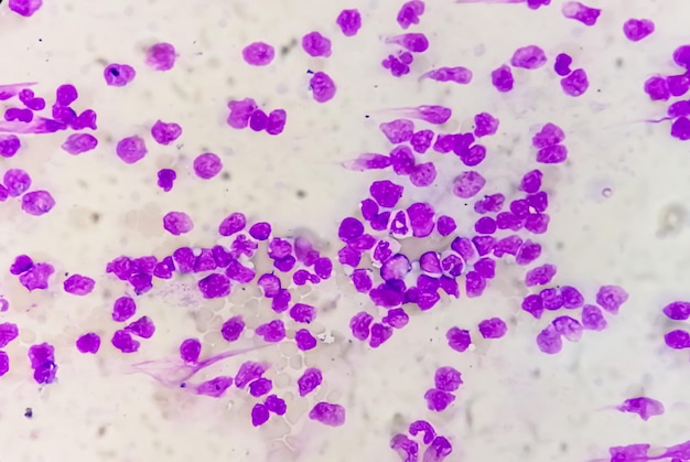 Frottis sanguin sous microscopie montrant une leucémie lymphoblastique chronique (LLC)