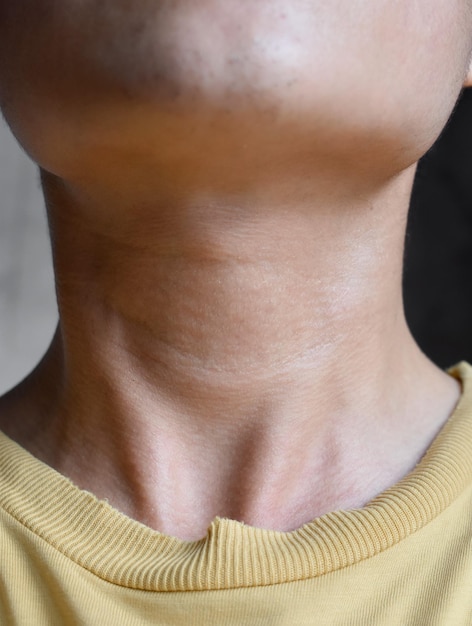 Gonflement du cou diagnostiqué comme hyperthyroïdie Vieillissement des plis cutanés ou des plis cutanés ou des rides au cou d'un jeune homme chinois asiatique