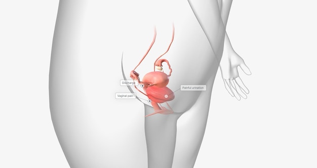 La gonorrhée est une infection sexuellement transmissible causée par la bactérie Neisseria gonorrhoeae