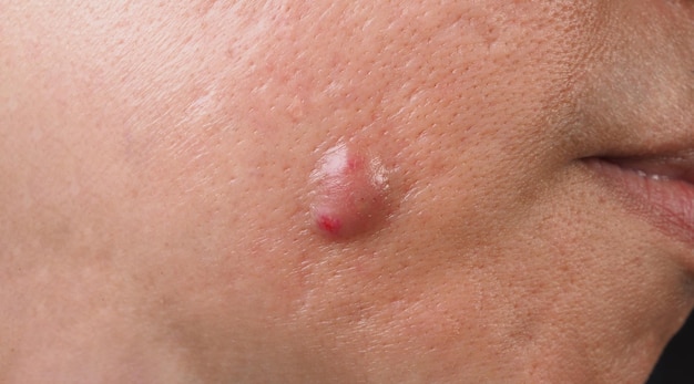 Photo gros kyste d'acné abcès ou ulcère zone enflée dans le tissu cutané du visage
