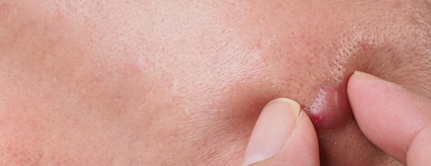 Gros kyste d'acné Abcès ou ulcère Zone enflée dans le tissu cutané du visage