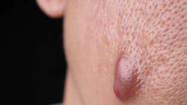 Gros kyste d'acné Abcès ou ulcère Zone enflée dans le tissu cutané du visage