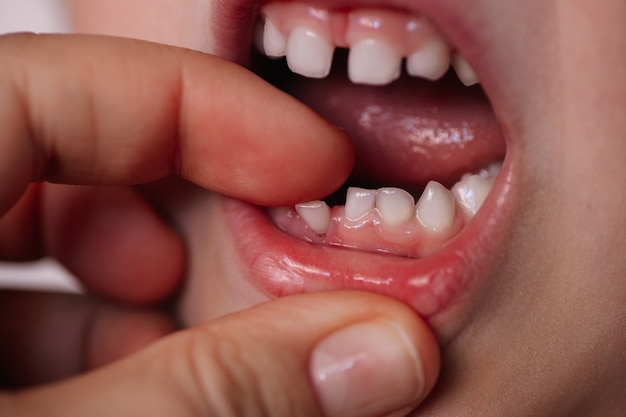 Gros Plan Bouche Ouverte D Un Enfant De Race Blanche Avec Une Dent De Bebe Tombant De La Gencive Photo Premium