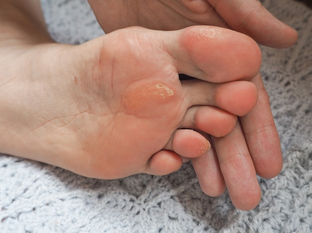 Photo gros plan des callosités. maïs douloureux à pied.