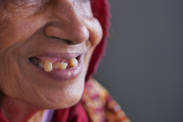 Gros plan sur les caries dentaires des femmes âgées et quelques dents cassées