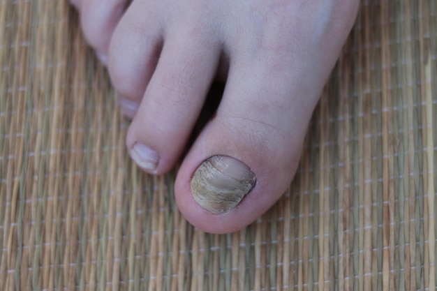 Gros plan de champignon sur l'ongle du pied