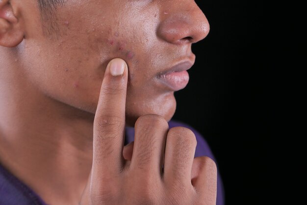 Gros plan du visage de jeune homme avec problème de peau.