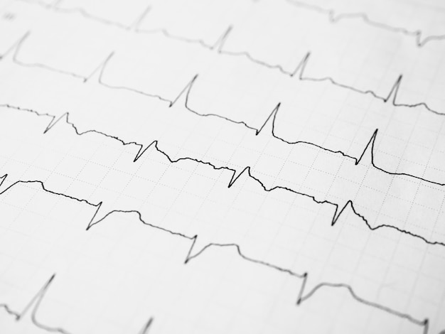 Photo gros plan d'un électrocardiogramme sous forme de papier papier d'enregistrement ecg ou ecg