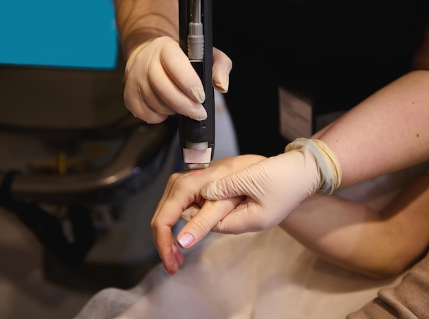 Gros plan sur l'élimination professionnelle des taches pigmentaires et des cheveux des mains à l'aide d'un laser médical dans une clinique thermale