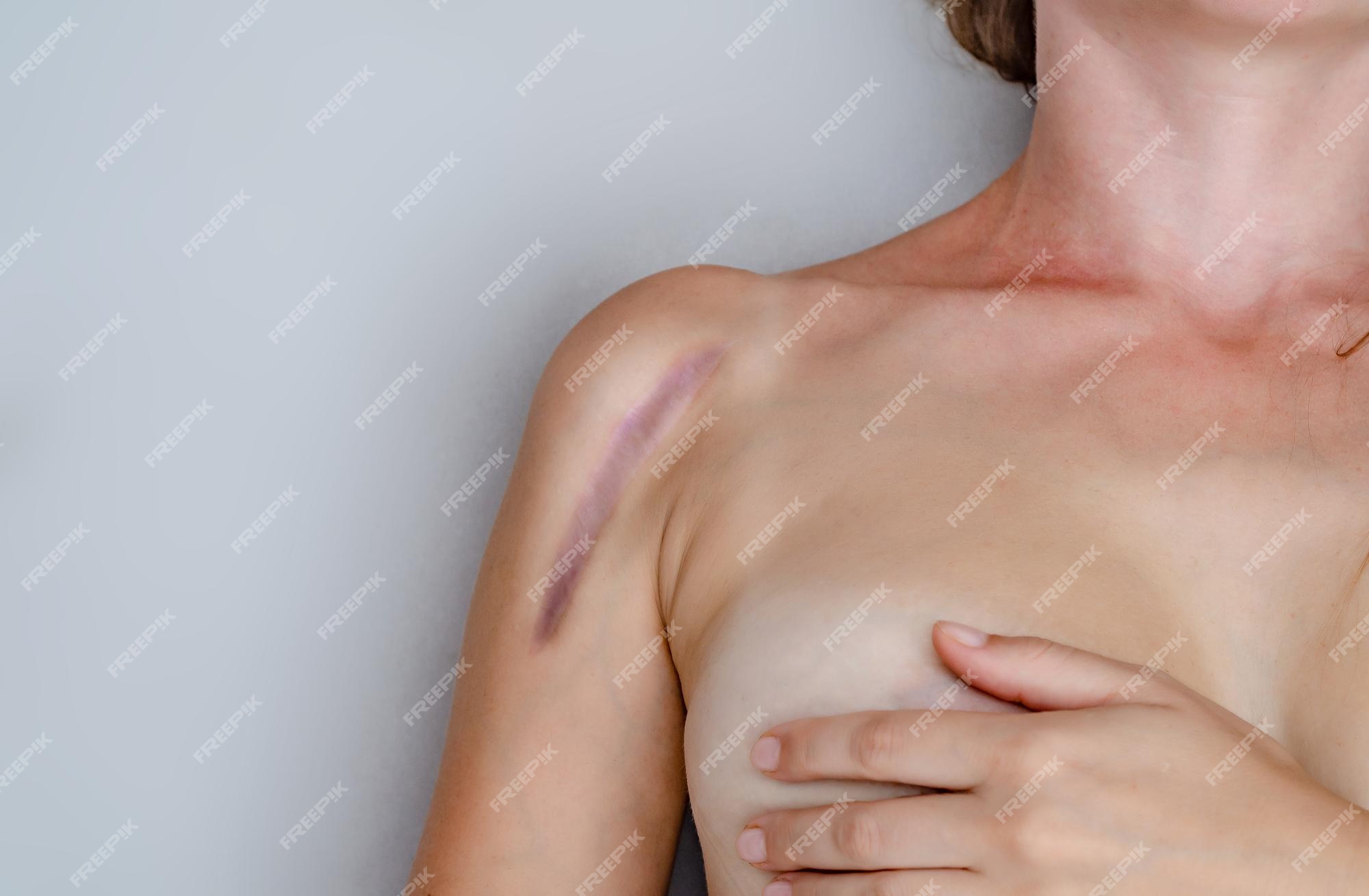 Gros Plan Sur Une épaule Féminine Avec Une Cicatrice Après L'installation  Chirurgicale D'une Fracture Osseuse Sur Plaque Métallique
