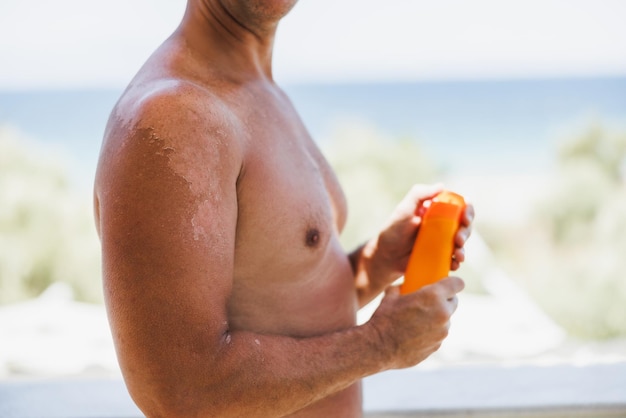 Gros plan sur l'épaule d'un homme avec un coup de soleil. La peau se détache de sa peau brûlée. C'est la cause du mélanome.