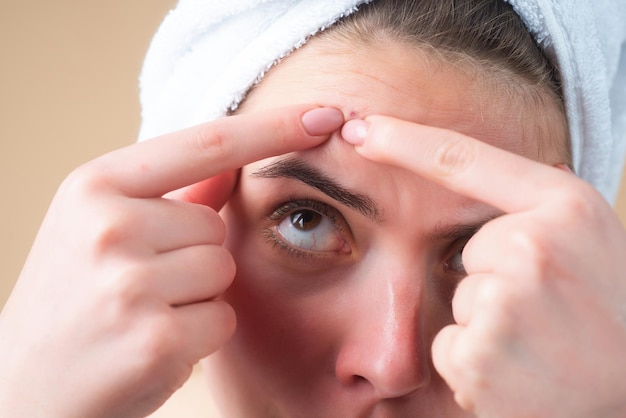 Photo en gros plan, la femme squeeze les boutons sur le front, l'acné et le boutons sur la peau, la dermatologie, la puberté, la femme.