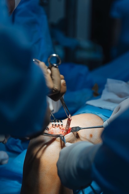 gros plan d'un genou humain amputé sur une table d'opération où une chirurgie de remplacement du genou est effectuée