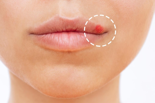 Gros plan d'herpès sur la lèvre. Cloques sur la bouche d'une jeune femme