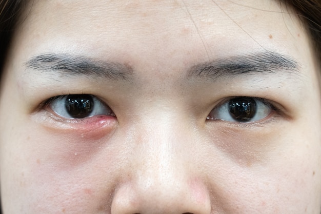 Photo gros plan d'une infection de l'oeil de belle femme asiatique (hordeolum).