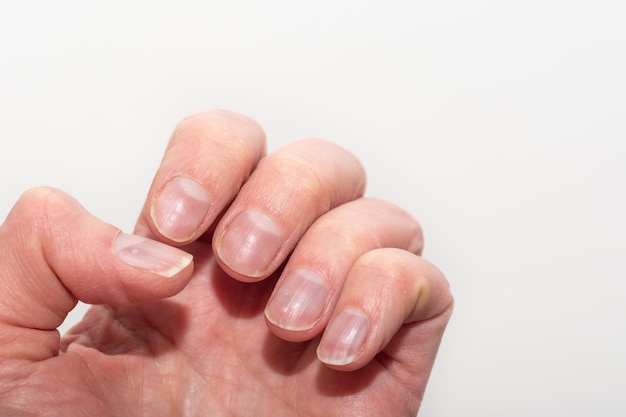 Photo gros plan d'une main de femme caucasienne avec des ongles naturels non polis, des cuticules envahies