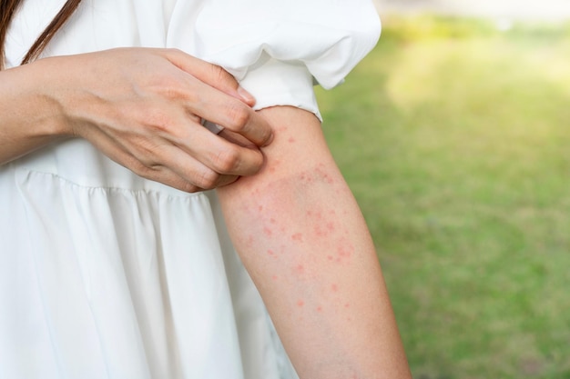 Gros plan sur une main de femme se grattant la peau avec des démangeaisons éruption cutanée allergique dermatite eczéma peau insecte allergie alimentaire concept de soins de santé