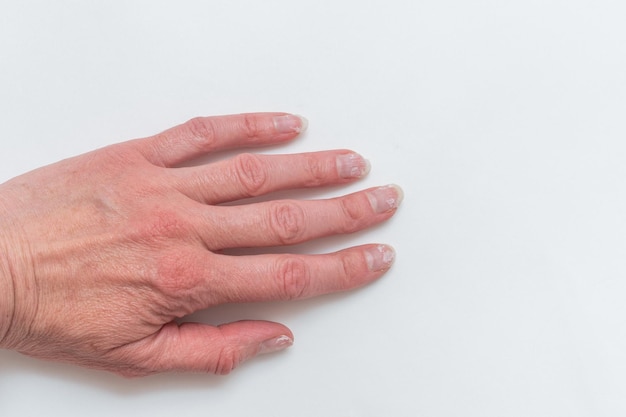 Gros plan de la main séculaire d'une femme avec des rides avec des ongles naturels envahis par la cuticule Doigts tordus la goutte