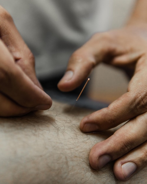 Gros plan de mains masculines appliquant une stylostixe d'acupuncture